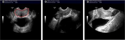 Semi-Automatic Prostate Segmentation From Ultrasound Images Using Machine Learning and Principal Curve Based on Interpretable Mathematical Model Expression